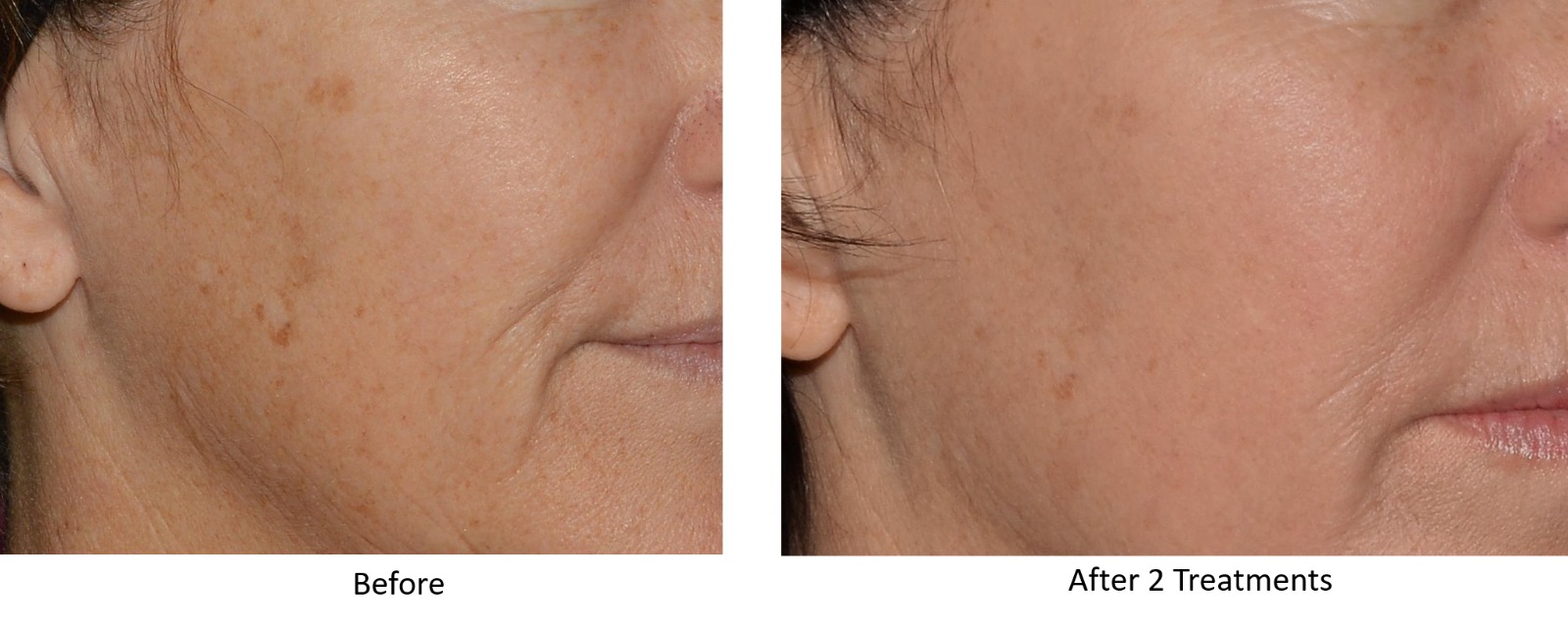 LaseMD Ultra Before and After - Age Spots